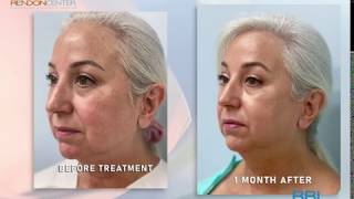 Before amp After Results of BBL IPL Laser Rendon Center Patient [upl. by Kazim730]