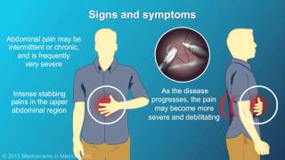 Chronic Pancreatitis [upl. by Nelyk]